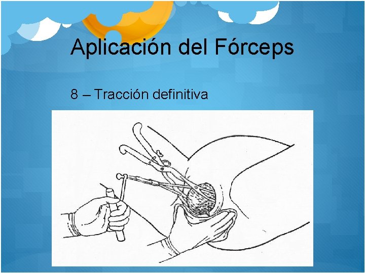 Aplicación del Fórceps 8 – Tracción definitiva 