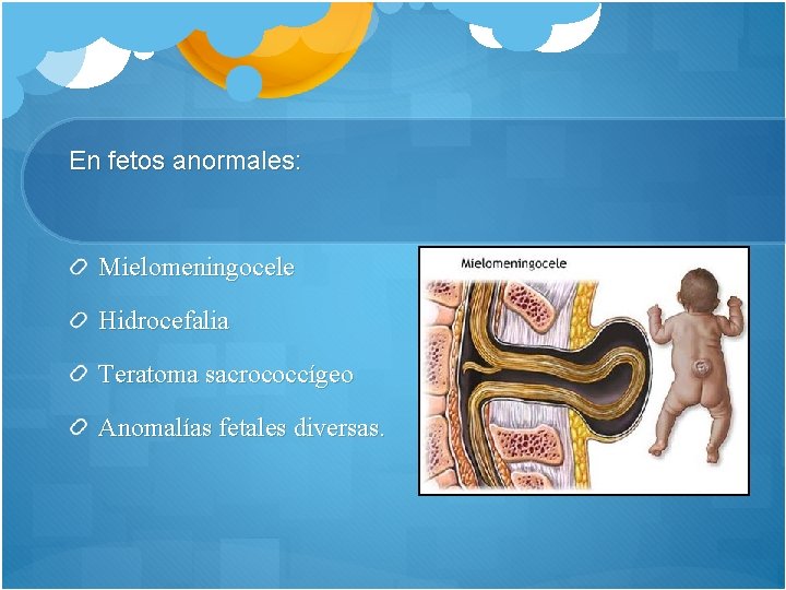 En fetos anormales: Mielomeningocele Hidrocefalia Teratoma sacrococcígeo Anomalías fetales diversas. 