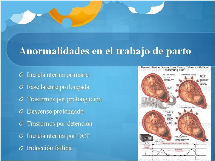 Anormalidades en el trabajo de parto Inercia uterina primaria Fase latente prolongada Trastornos por