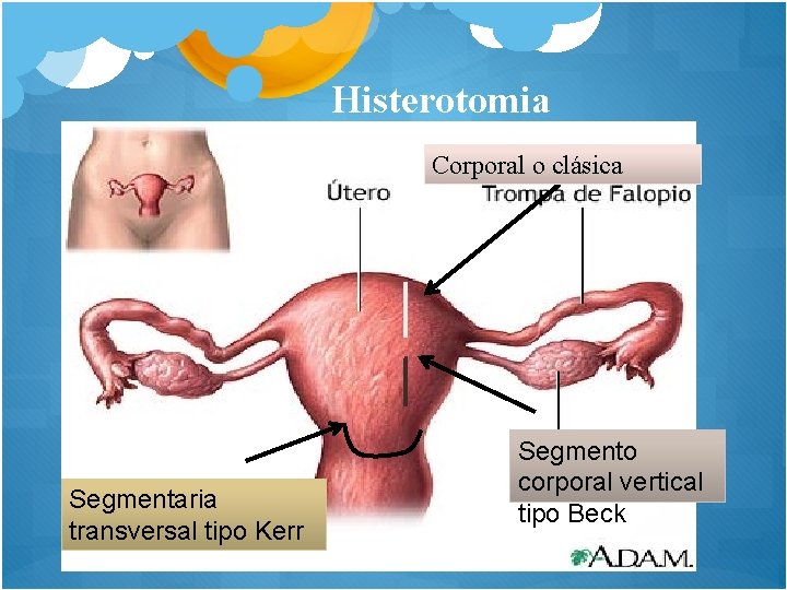 Histerotomia Corporal o clásica Segmentaria transversal tipo Kerr Segmento corporal vertical tipo Beck 