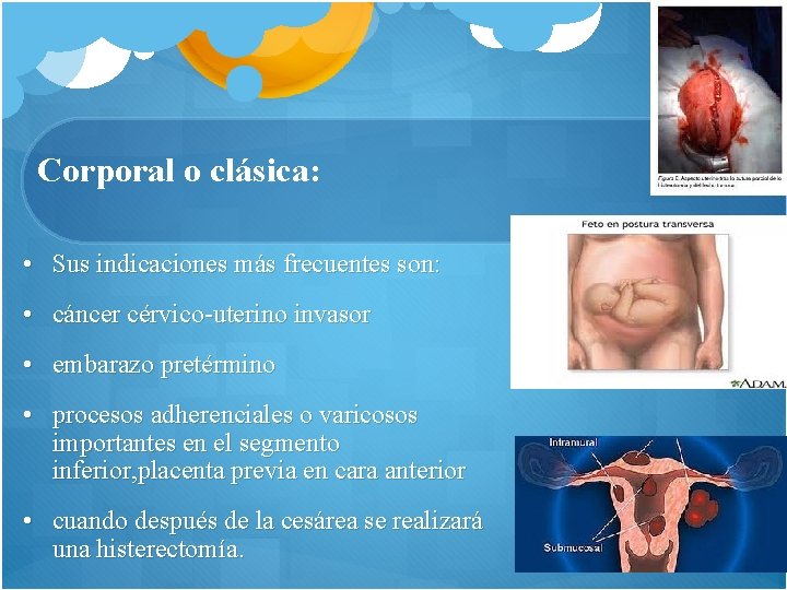 Corporal o clásica: • Sus indicaciones más frecuentes son: • cáncer cérvico-uterino invasor •