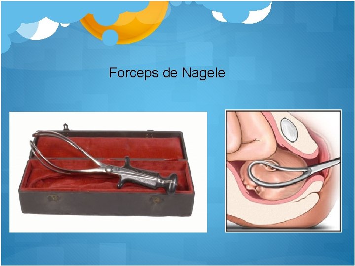 Forceps de Nagele 