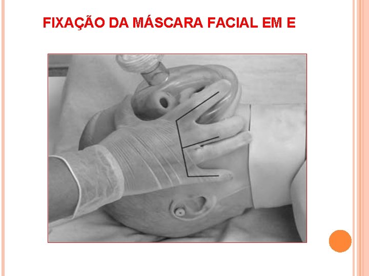 FIXAÇÃO DA MÁSCARA FACIAL EM E 