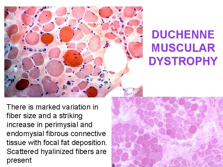 DUCHENNE MUSCULAR DYSTROPHY There is marked variation in fiber size and a striking increase
