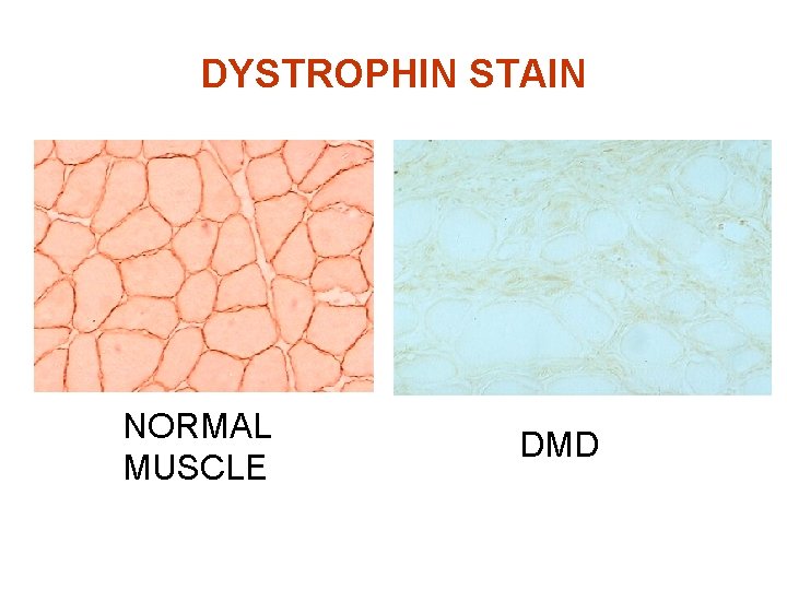 DYSTROPHIN STAIN NORMAL MUSCLE DMD 