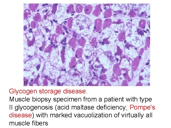 Glycogen storage disease. Muscle biopsy specimen from a patient with type II glycogenosis (acid