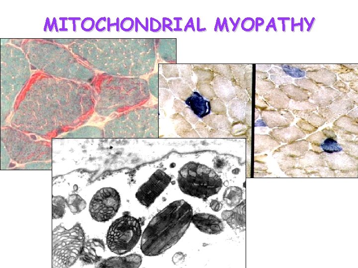MITOCHONDRIAL MYOPATHY 