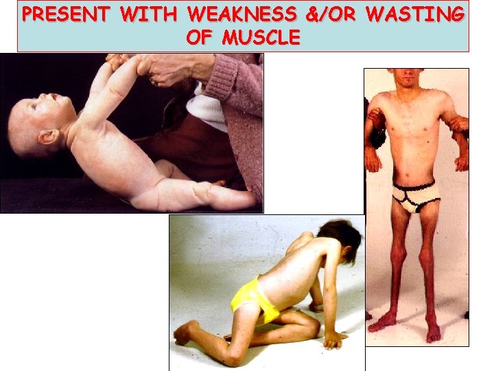 PRESENT WITH WEAKNESS &/OR WASTING OF MUSCLE 