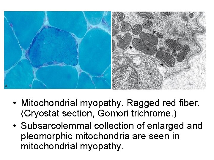  • Mitochondrial myopathy. Ragged red fiber. (Cryostat section, Gomori trichrome. ) • Subsarcolemmal