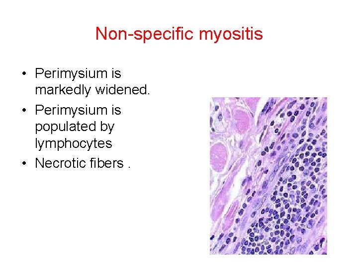 Non-specific myositis • Perimysium is markedly widened. • Perimysium is populated by lymphocytes •