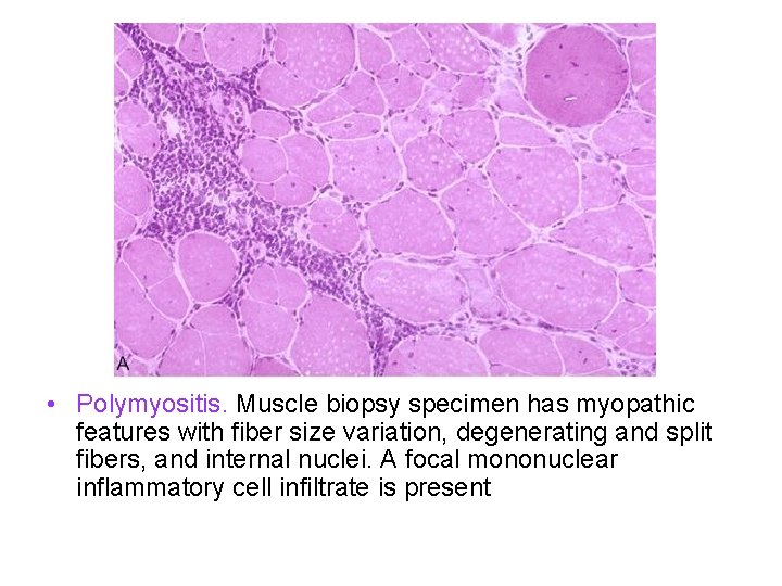  • Polymyositis. Muscle biopsy specimen has myopathic features with fiber size variation, degenerating