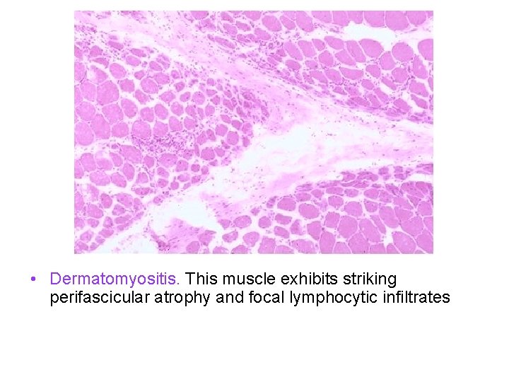  • Dermatomyositis. This muscle exhibits striking perifascicular atrophy and focal lymphocytic infiltrates 