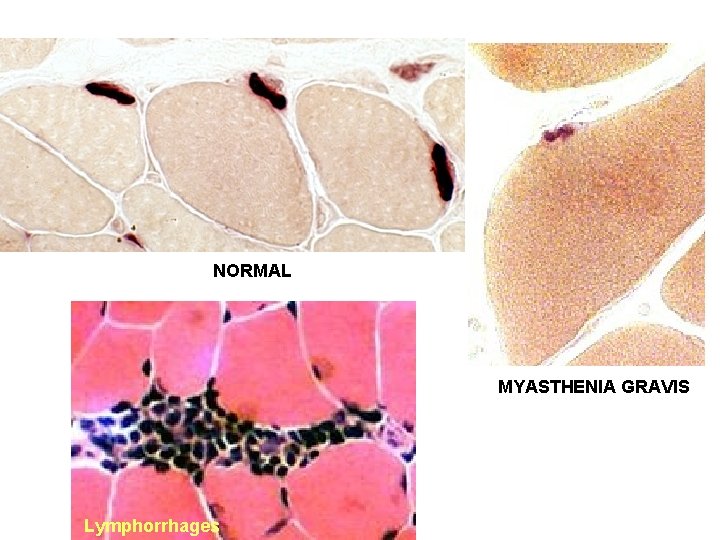 NORMAL MYASTHENIA GRAVIS Lymphorrhages 