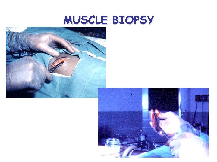 MUSCLE BIOPSY 