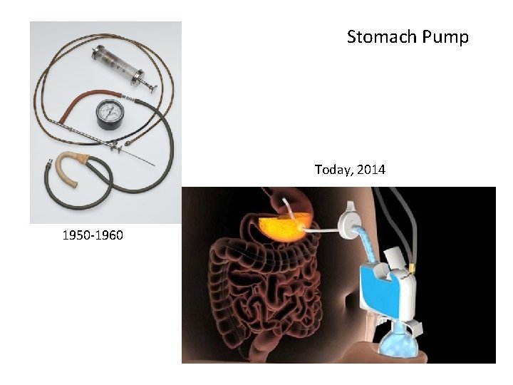 Stomach Pump Today, 2014 1950 -1960 