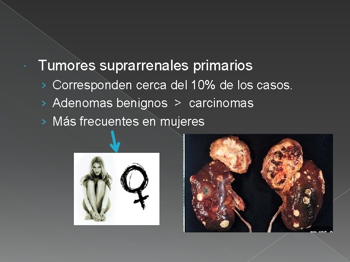  Tumores suprarrenales primarios › Corresponden cerca del 10% de los casos. › Adenomas