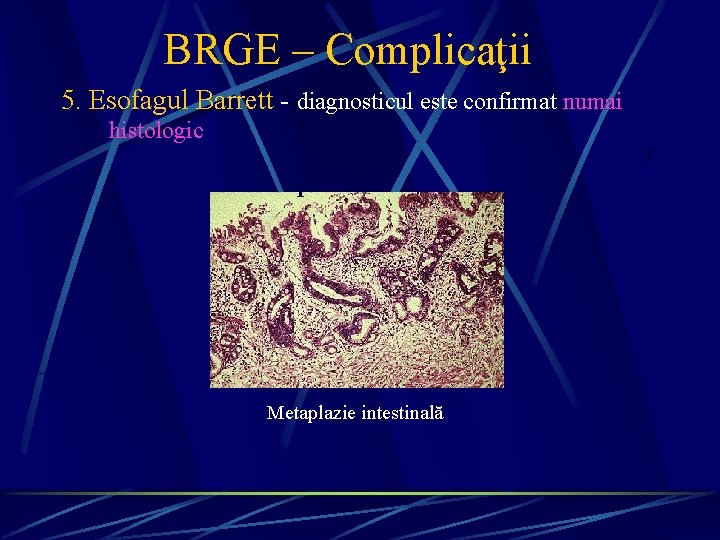 BRGE – Complicaţii 5. Esofagul Barrett - diagnosticul este confirmat numai histologic 2 1