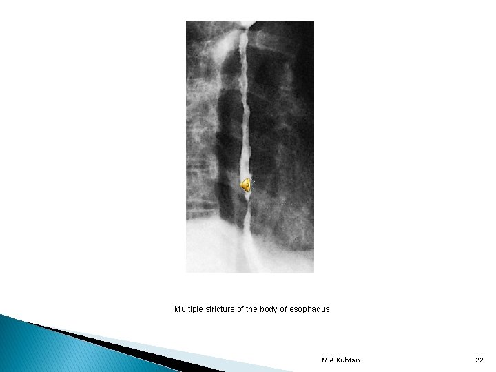 Multiple stricture of the body of esophagus M. A. Kubtan 22 