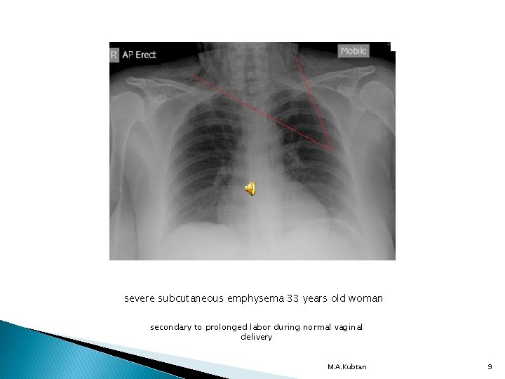 severe subcutaneous emphysema 33 years old woman secondary to prolonged labor during normal vaginal