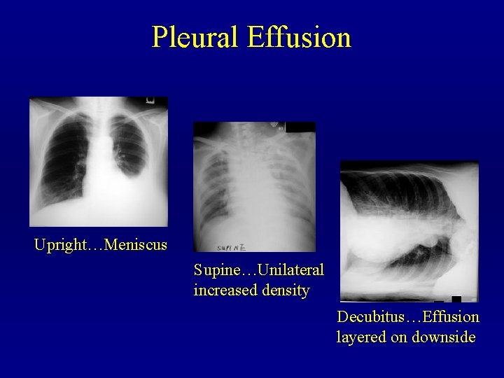 Pleural Effusion Upright…Meniscus Supine…Unilateral increased density Decubitus…Effusion layered on downside 