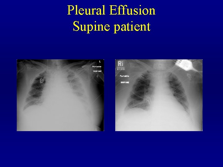 Pleural Effusion Supine patient 