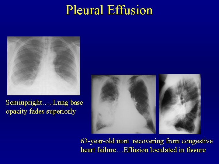 Pleural Effusion Semiupright…. . Lung base opacity fades superiorly 63 -year-old man recovering from