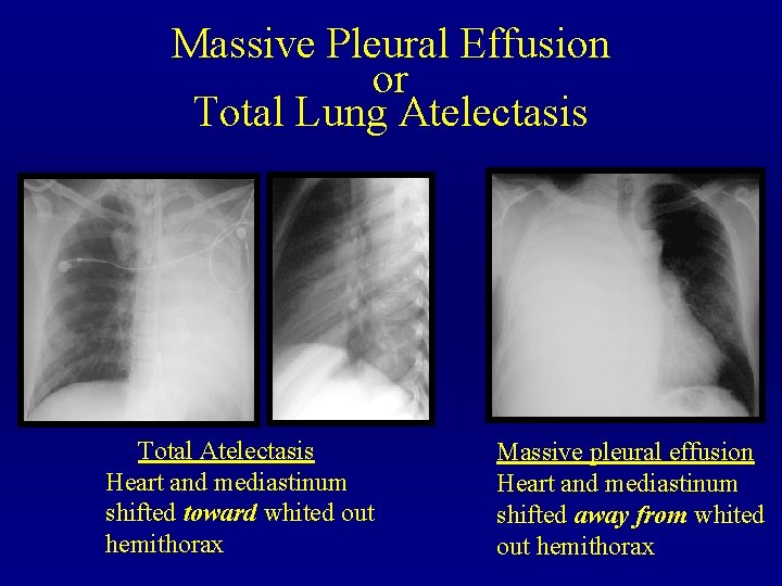 Massive Pleural Effusion or Total Lung Atelectasis Total Atelectasis Heart and mediastinum shifted toward