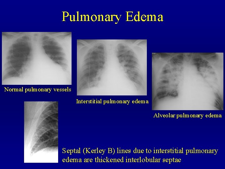 Pulmonary Edema Normal pulmonary vessels Interstitial pulmonary edema Alveolar pulmonary edema Septal (Kerley B)