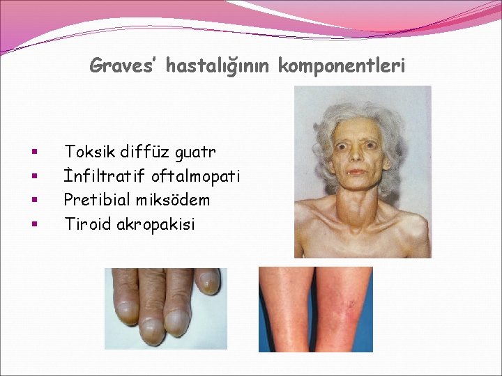 Graves’ hastalığının komponentleri § § Toksik diffüz guatr İnfiltratif oftalmopati Pretibial miksödem Tiroid akropakisi Graves’ hastalığının komponentleri § § Toksik diffüz guatr İnfiltratif oftalmopati Pretibial miksödem Tiroid akropakisi