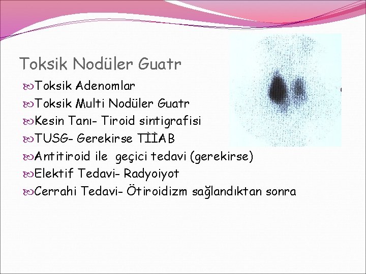 Toksik Nodüler Guatr Toksik Adenomlar Toksik Multi Nodüler Guatr Kesin Tanı- Tiroid sintigrafisi TUSG- Toksik Nodüler Guatr Toksik Adenomlar Toksik Multi Nodüler Guatr Kesin Tanı- Tiroid sintigrafisi TUSG-