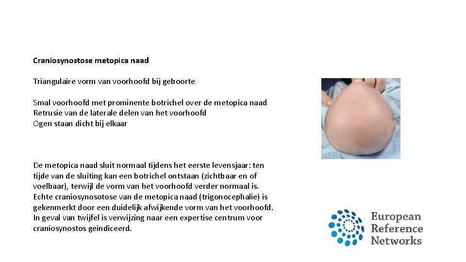Craniosynostose metopica naad Triangulaire vorm van voorhoofd bij geboorte Smal voorhoofd met prominente botrichel