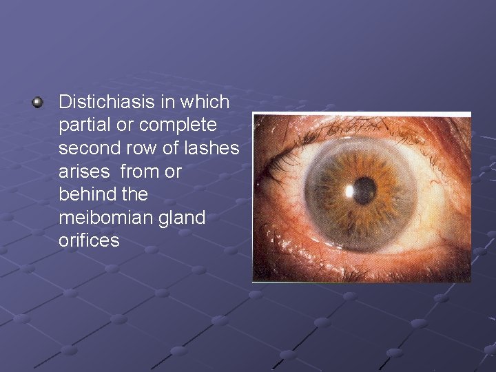 Distichiasis in which partial or complete second row of lashes arises from or behind