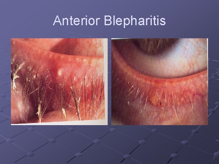 Anterior Blepharitis 
