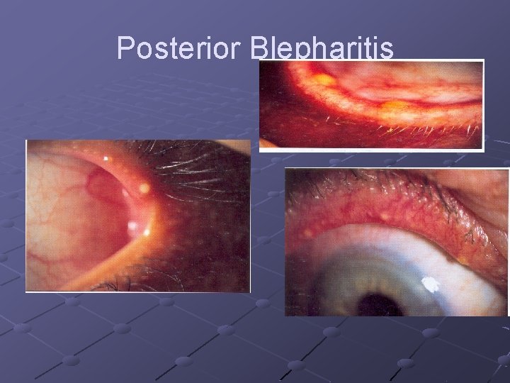 Posterior Blepharitis 