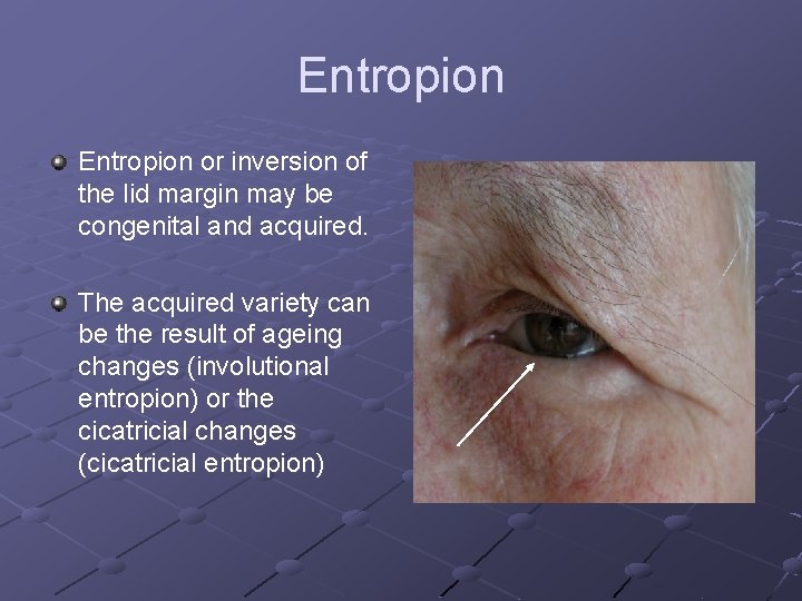 Entropion or inversion of the lid margin may be congenital and acquired. The acquired