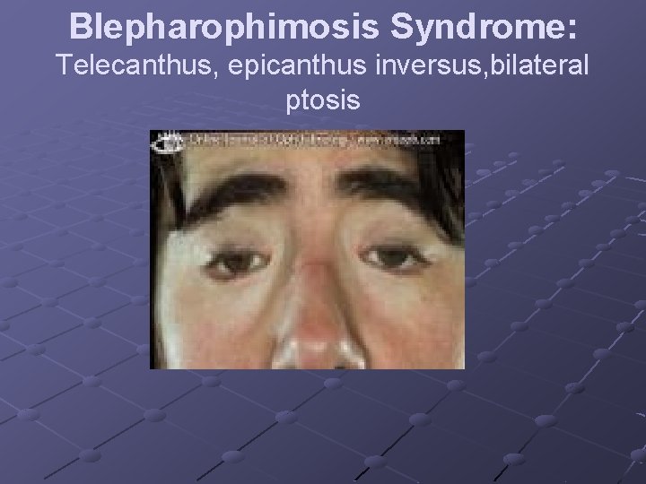 Blepharophimosis Syndrome: Telecanthus, epicanthus inversus, bilateral ptosis 