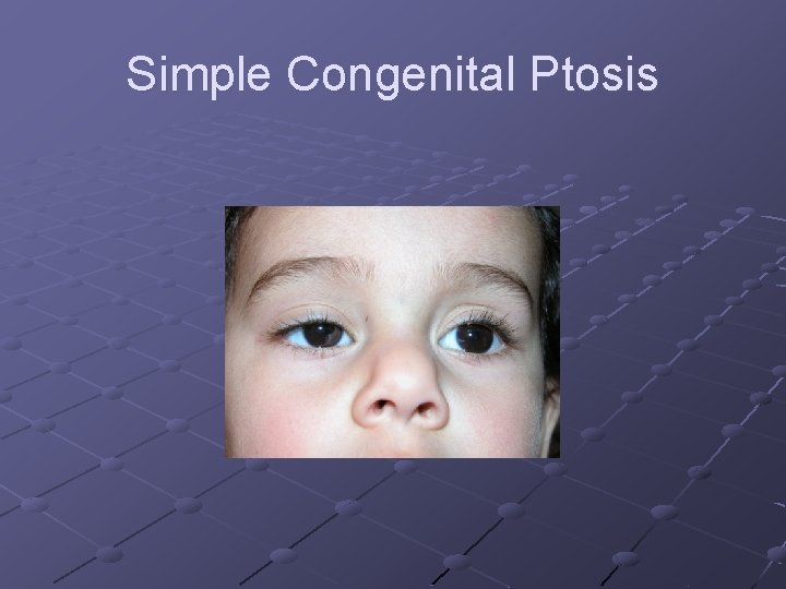 Simple Congenital Ptosis 