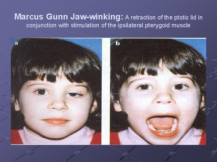 Marcus Gunn Jaw-winking: A retraction of the ptotic lid in conjunction with stimulation of