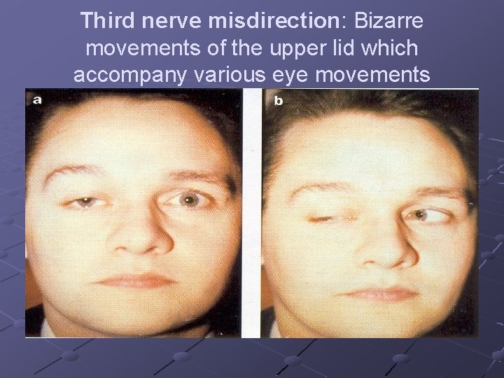 Third nerve misdirection: Bizarre movements of the upper lid which accompany various eye movements