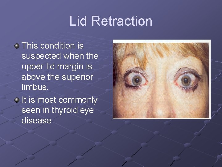 Lid Retraction This condition is suspected when the upper lid margin is above the