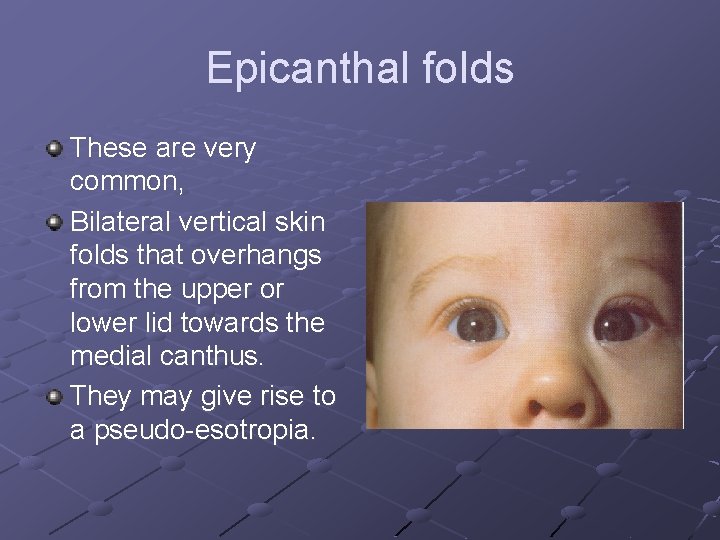 Epicanthal folds These are very common, Bilateral vertical skin folds that overhangs from the