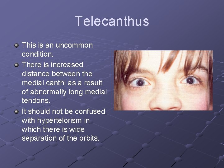 Telecanthus This is an uncommon condition. There is increased distance between the medial canthi
