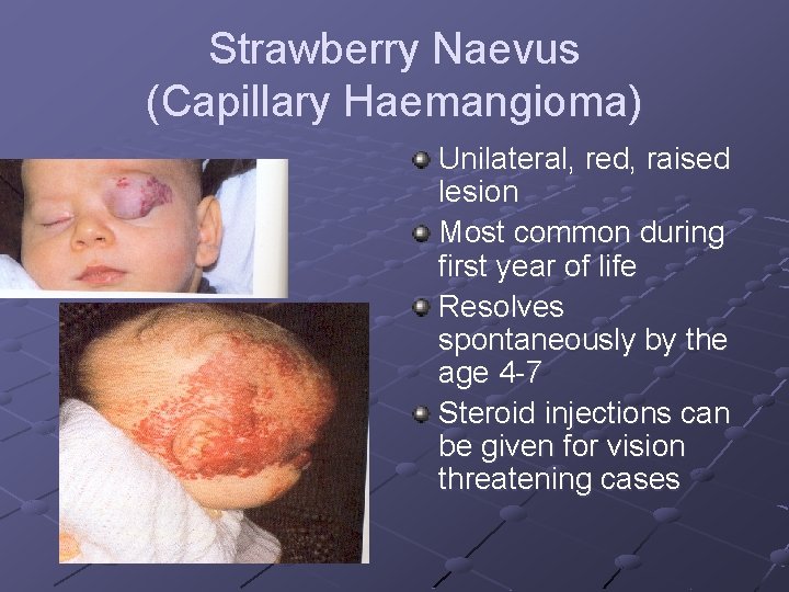 Strawberry Naevus (Capillary Haemangioma) Unilateral, red, raised lesion Most common during first year of