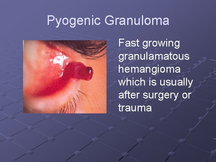 Pyogenic Granuloma Fast growing granulamatous hemangioma which is usually after surgery or trauma 