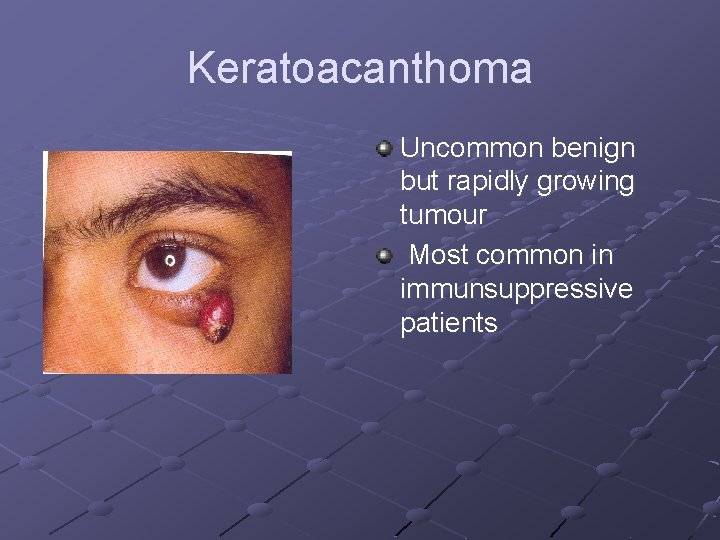 Keratoacanthoma Uncommon benign but rapidly growing tumour Most common in immunsuppressive patients 