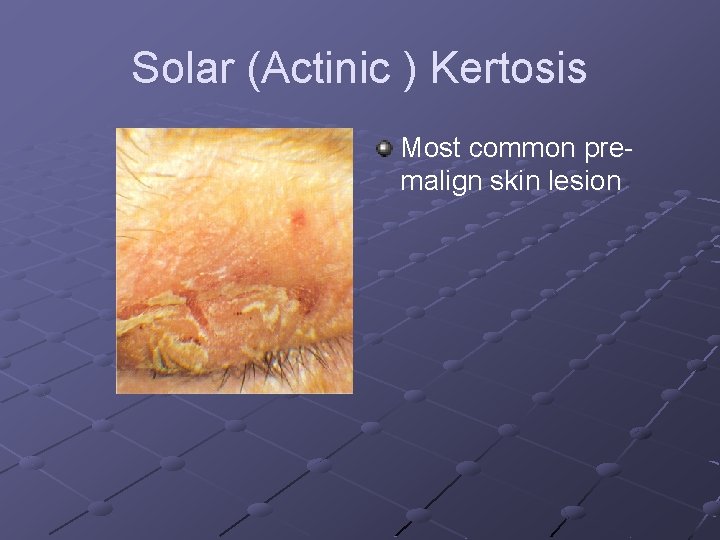 Solar (Actinic ) Kertosis Most common premalign skin lesion 