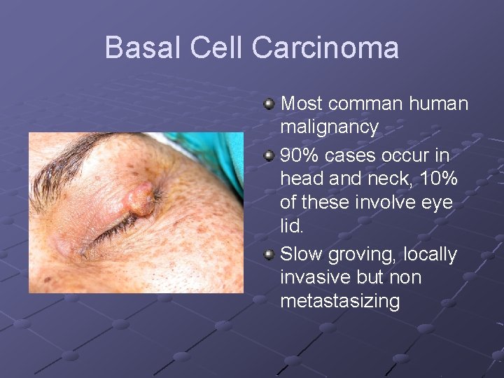 Basal Cell Carcinoma Most comman human malignancy 90% cases occur in head and neck,