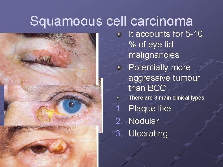 Squamoous cell carcinoma It accounts for 5 -10 % of eye lid malignancies Potentially