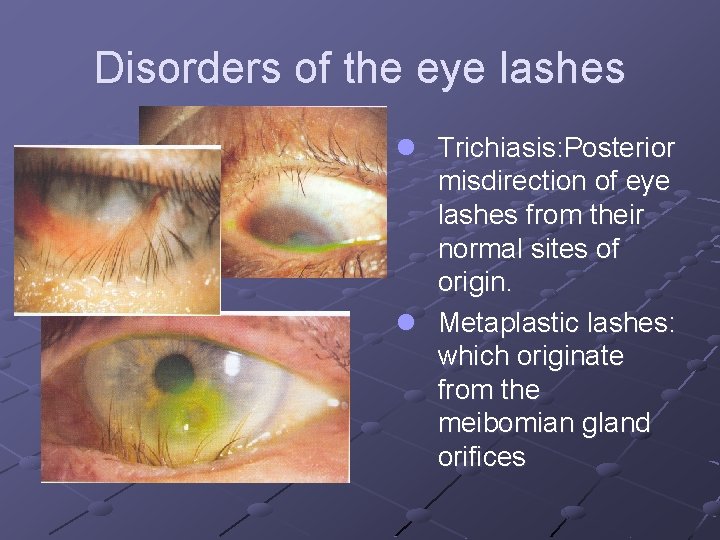 Disorders of the eye lashes l Trichiasis: Posterior misdirection of eye lashes from their