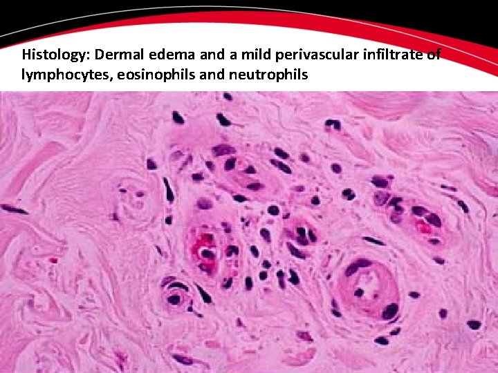 Histology: Dermal edema and a mild perivascular infiltrate of lymphocytes, eosinophils and neutrophils Histology: Dermal edema and a mild perivascular infiltrate of lymphocytes, eosinophils and neutrophils